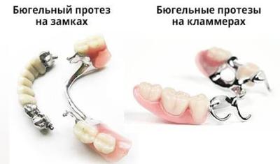Протезирование зубов