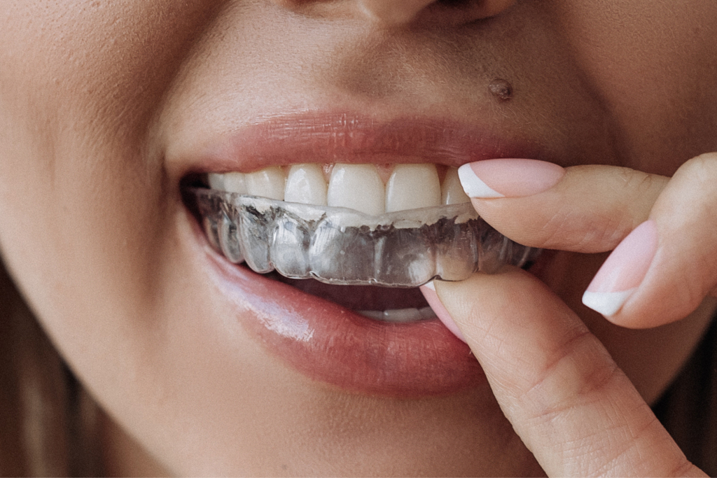 Элайнеры Invisalign